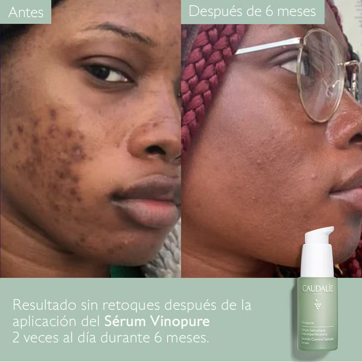 Vinopure Sérum Salicílico Anti-imperfeições